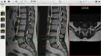 Spine Labeling